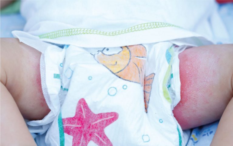 Menangani Ruam Lampin - BabyTalk - Baby & Kids, Pregnancy & Parenting
