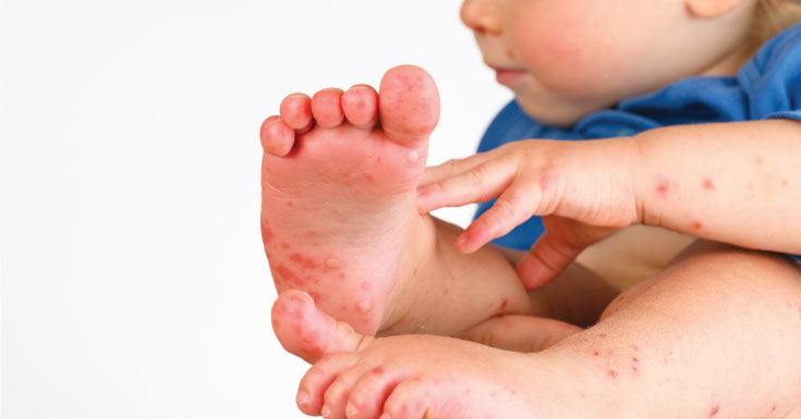 An Insight into Hand, Foot and Mouth Disease (HFMD) - BabyTalk - Baby ...